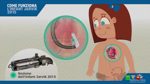 OPBG, Infant Jarvik 2015, Come funziona il mini cuore artificiale