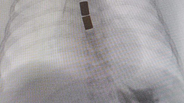 OPBG Ospedale Pediatrico Bambino Gesù – Magneti al posto della chirurgia per riparare l’esofago 