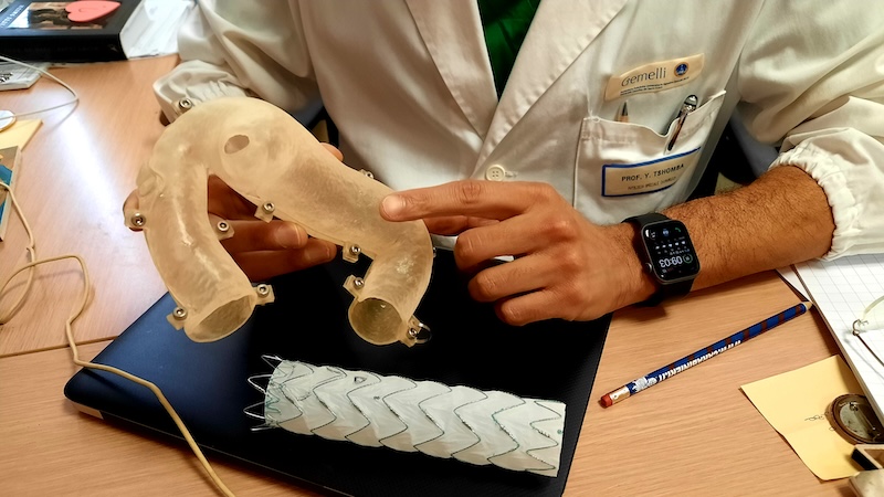 Al Gemelli chirurgia vascolare ‘di precisione’ con una protesi aortica ‘ritagliata’ su misura per il paziente